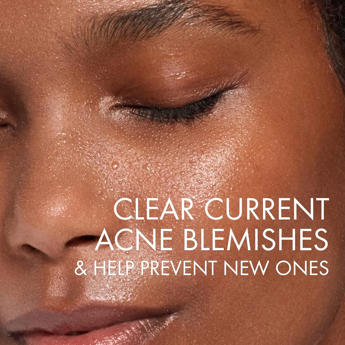 VICHY Normaderm Acne Face Wash – Salicylic Cleanser for Oily Skin